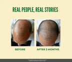 Before and after comparison of hair growth on a person's head with text 'Real People, Real Stories' on a beige background.
